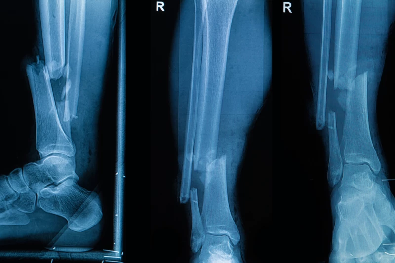 Переносной 3D-принтер для костной ткани разработан международными учёными